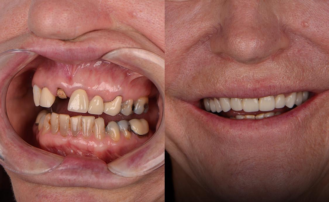 Rehabilitación superior completa