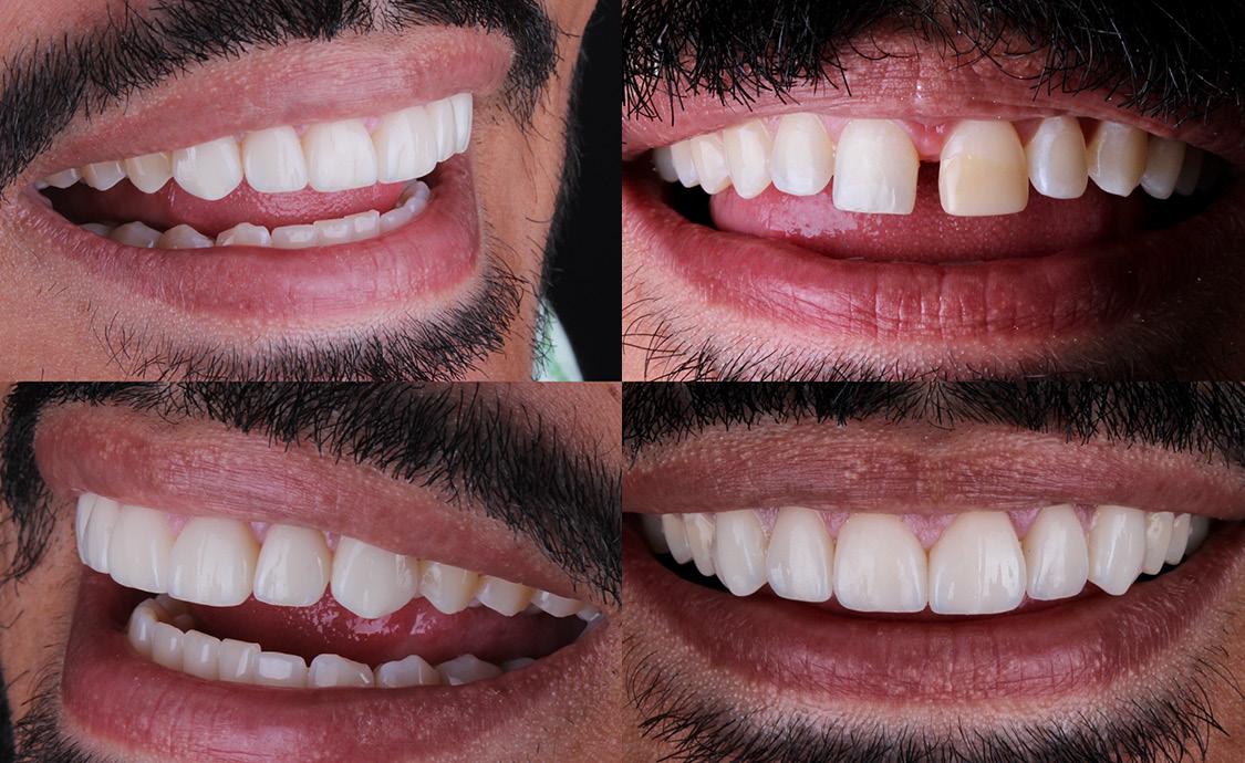 Carillas de porcelana